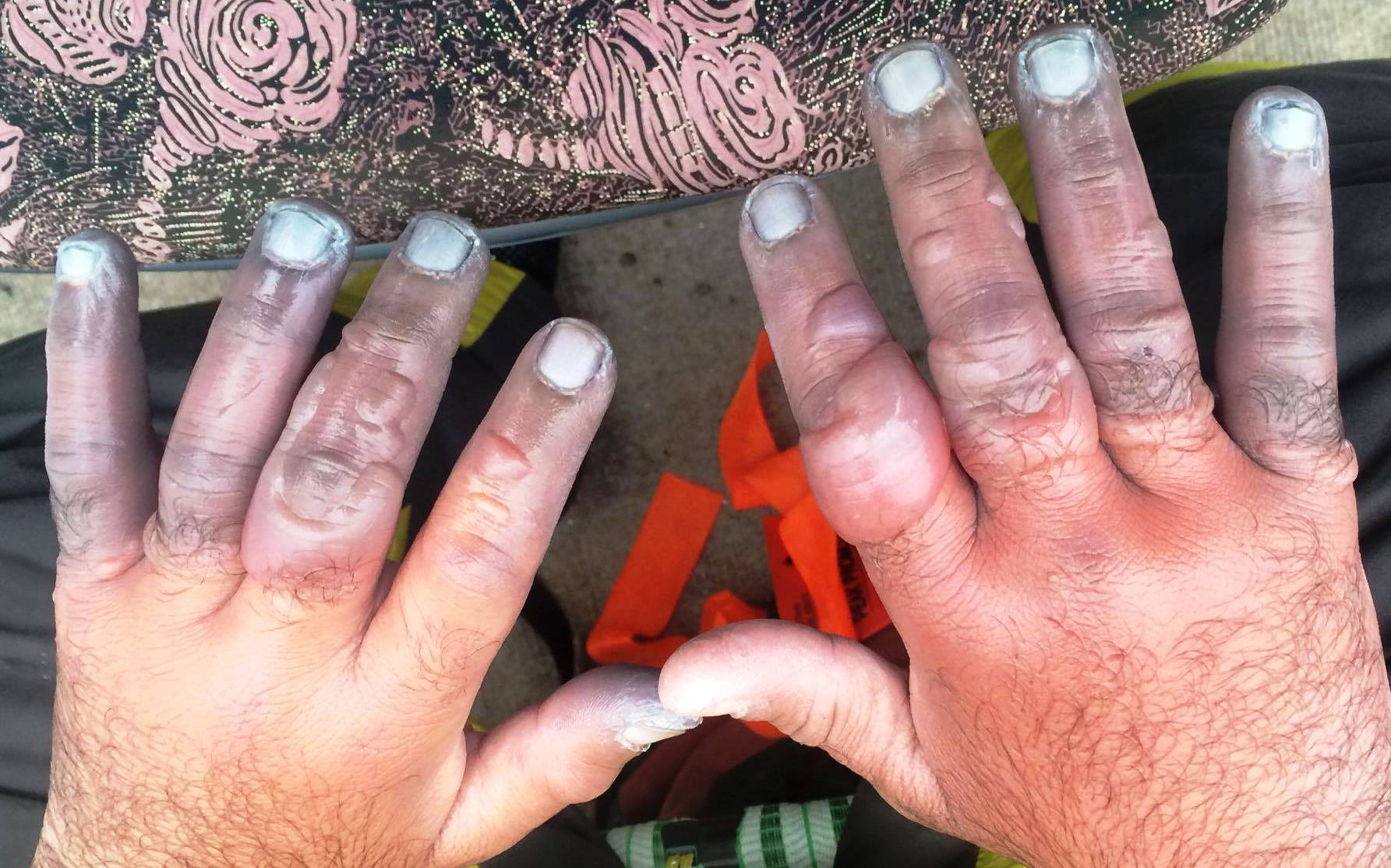 Everest 2016 frostbite The Blog on