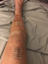 Alan leg 3 weeks out