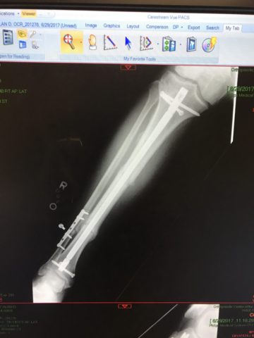 Broken leg 5 months out