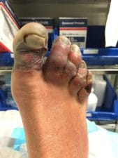 2016 Everest Frostbite