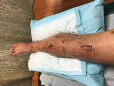 Alan leg with sutures