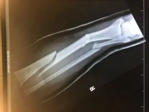 Broken Tibia X Ray