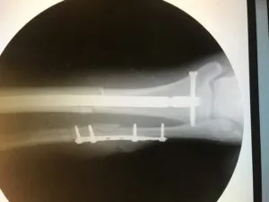 After Surgery X Ray