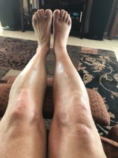 legs 8 weeks after Twin Sisters Fall
